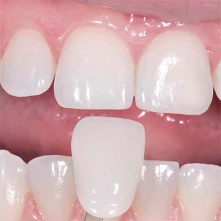 Carillas dentales, tratamiento de estética dental