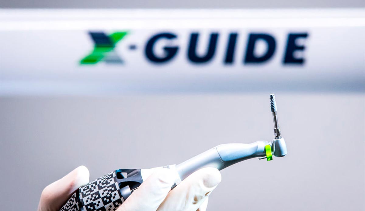 mejor tecnología para colocar los implantes dentales