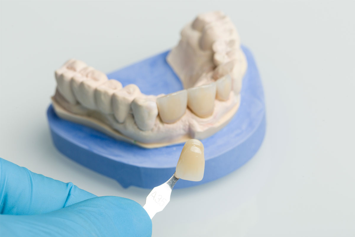 3 tipos de manchas dentales y cómo pueden tratarse con odontología estética
