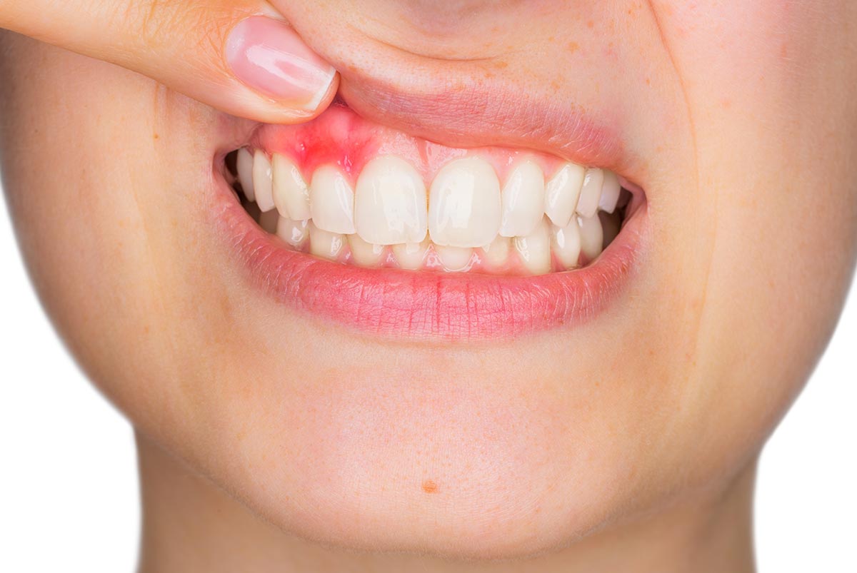 Absceso o flemón dental, qué es y cómo tratarlo
